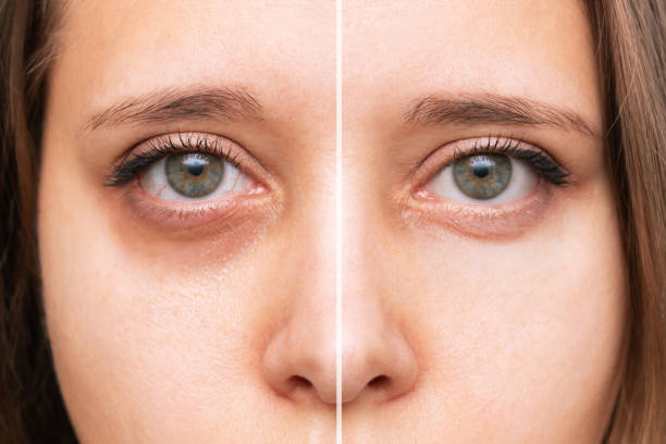 MOST EFFECTIVE WAYS TO GET RID OF UNDER-EYE BAGS