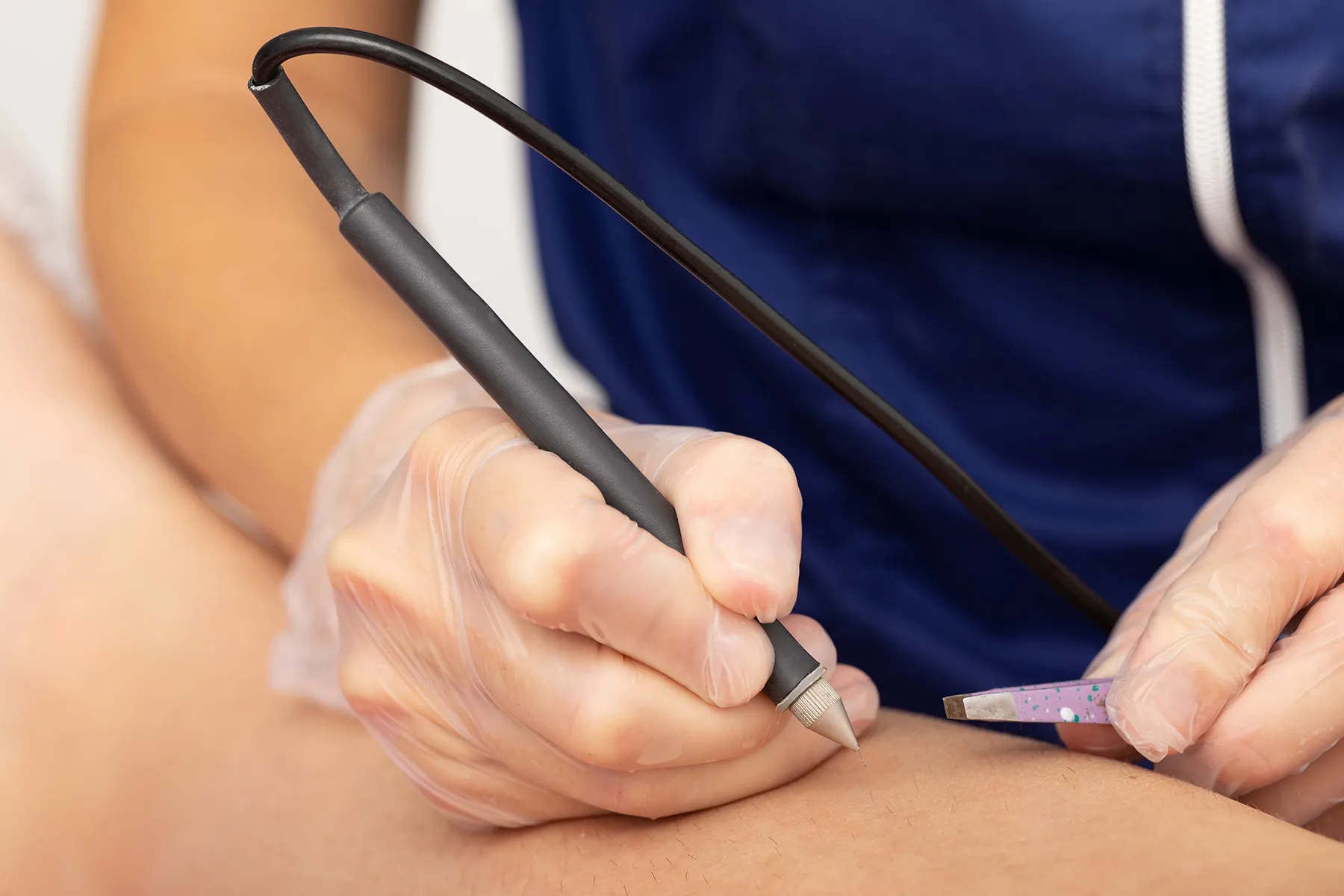 Top 5 Reasons Why You Should Choose Galvanic Electrolysis for Permanent Hair Removal